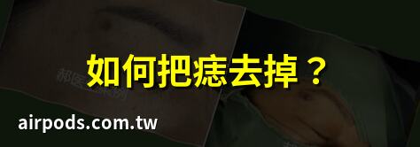 如何把痣去掉？｜痣要怎麼消掉？瞭解常見的去除方法與注意事項
